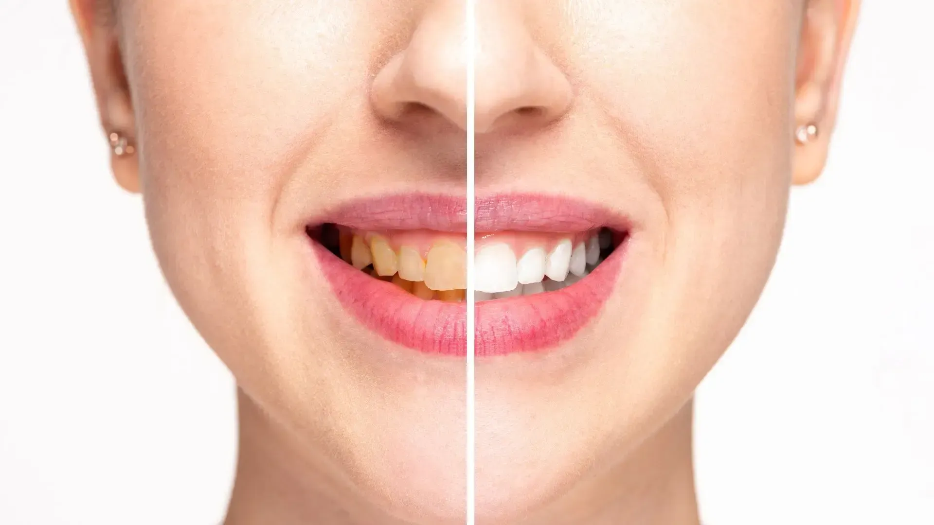 A woman 's teeth before and after whitening.