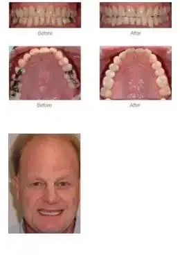 Functional Makeover - Tooth Whitening Case Study at Duxton Dental Christchurch