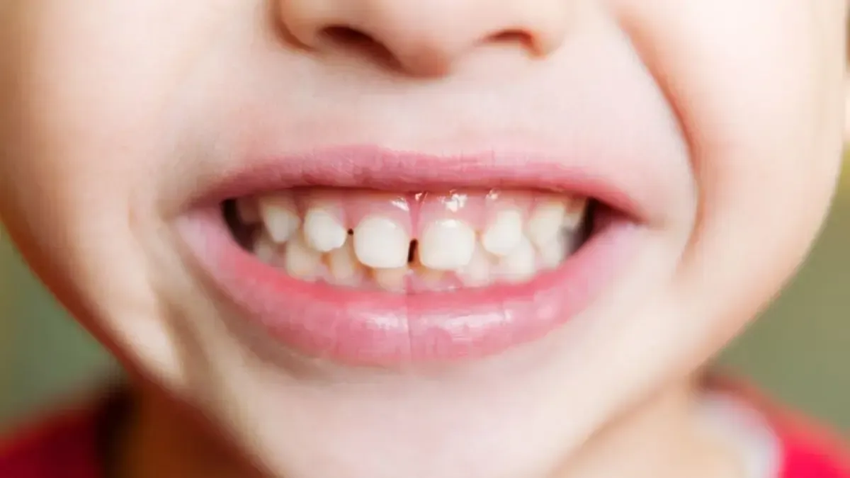 Close-up of a child's smiling mouth showing several teeth, with a gap between the front two.