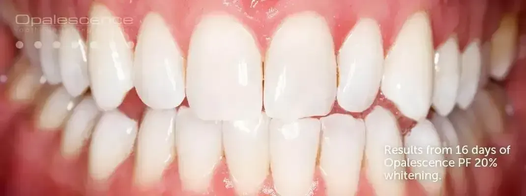 Results from 16 days of Opalescence whitening