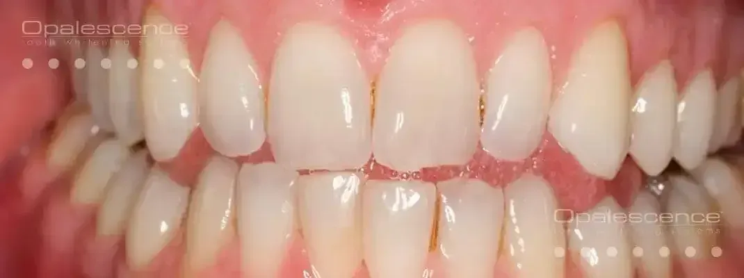 teeth before undergoing a whitening treatment