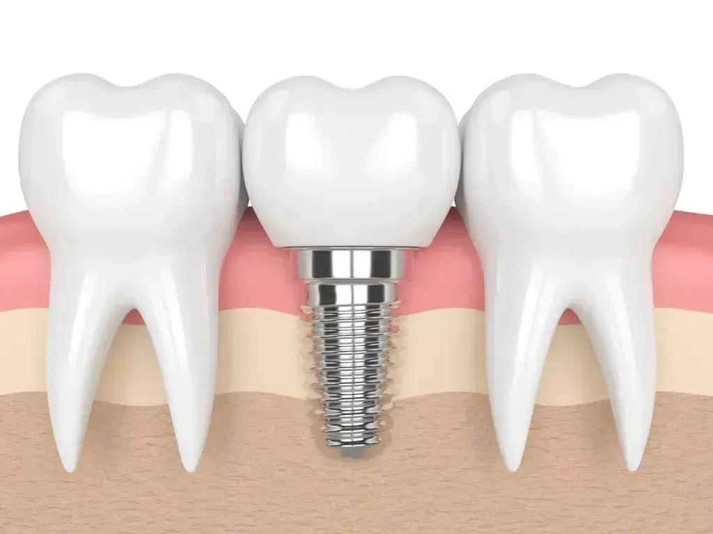 Dental implant between two teeth, illustration. White tooth crown on a silver implant post, set in gums.