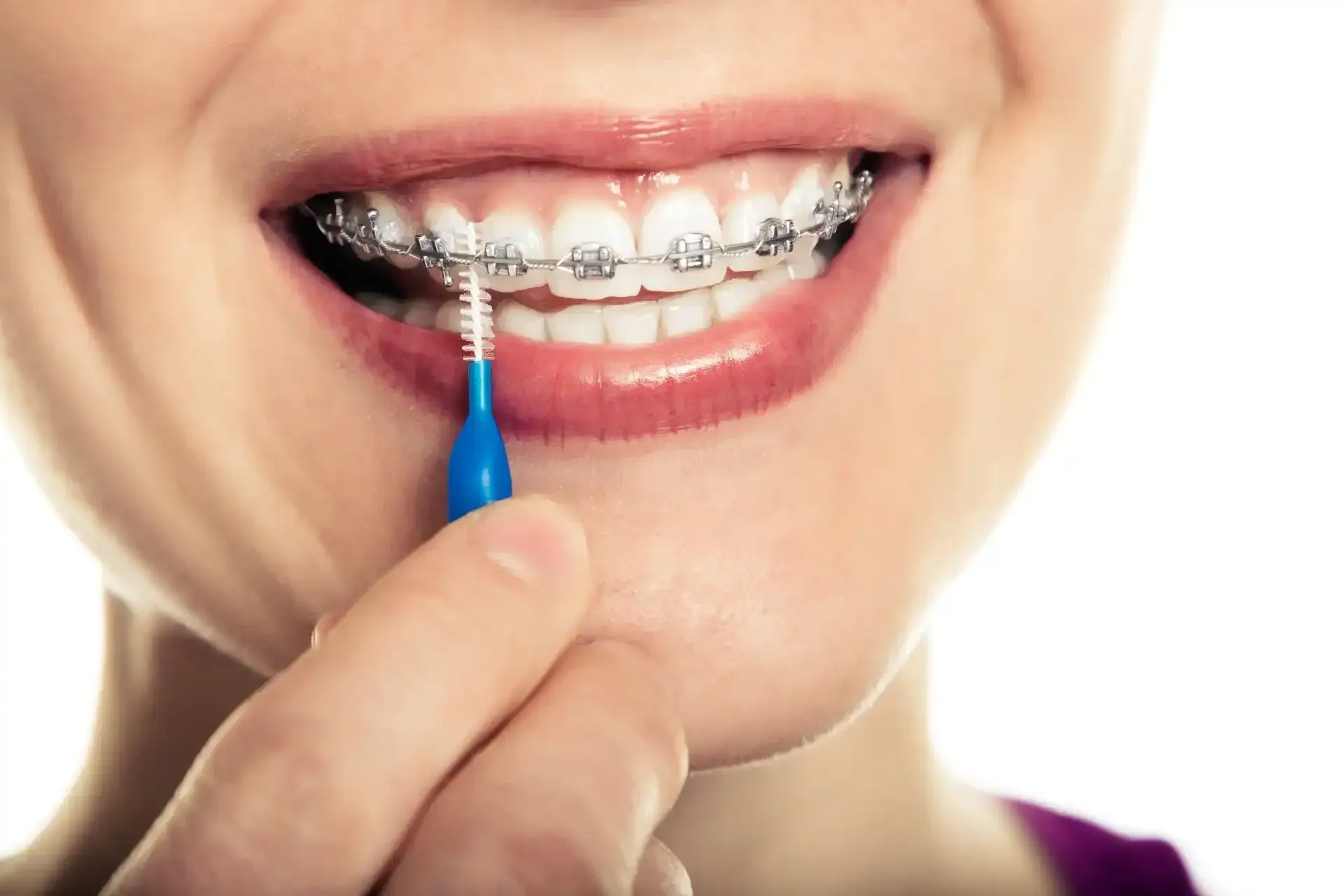 Cleaning braces with small brush