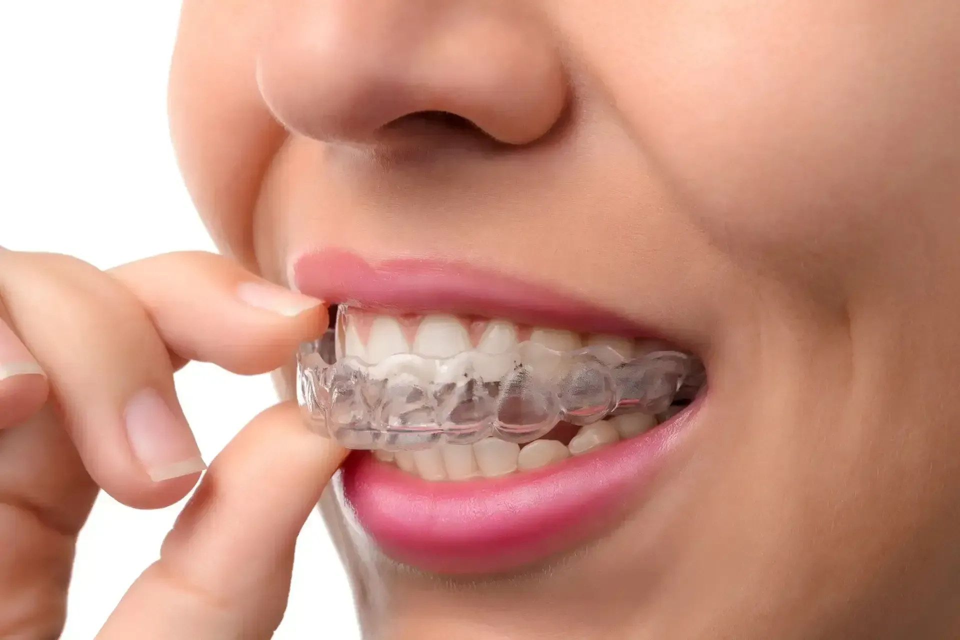 Invisalign clear aligner