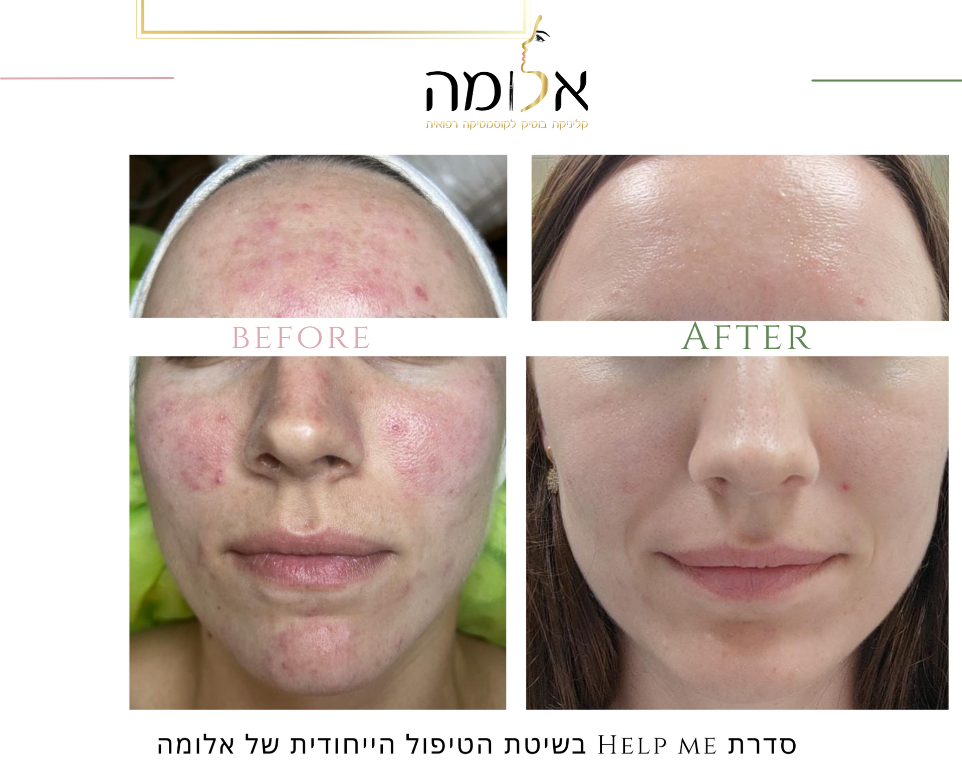 לפני ואחרי טיפול פנים