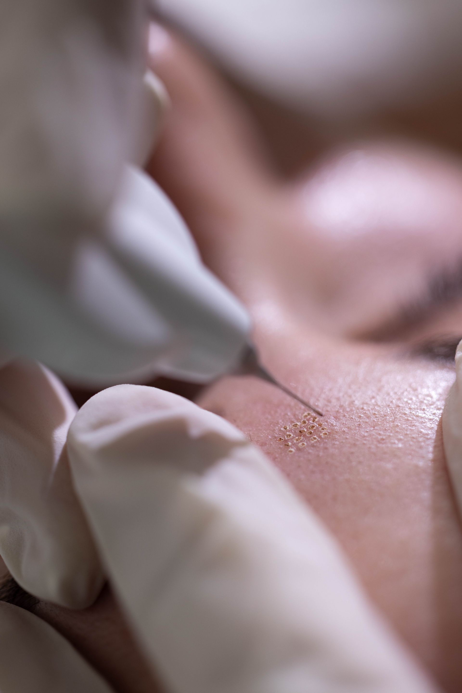 Gloved hands examining a small skin spot during a close-up medical procedure