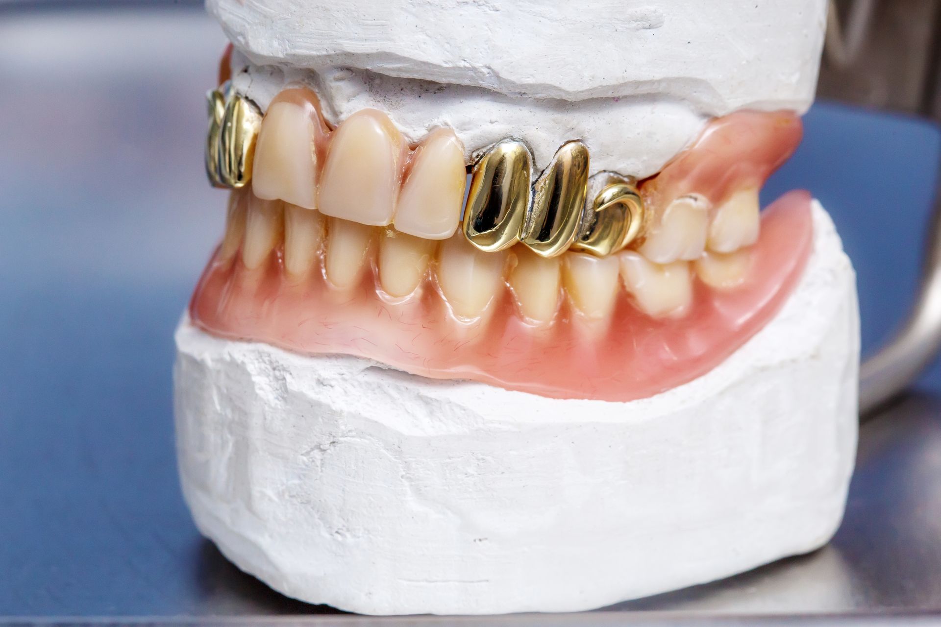 Dental model of teeth with gold crowns on a pink gum base in a white plaster mold.