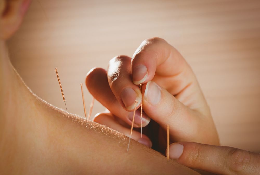 Young Woman Getting Acupuncture Treatment In Therapy Room — Resonance Health Studio in Wauchope, NSW