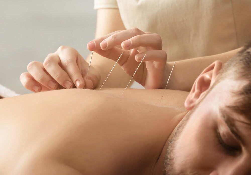 A Person Is Getting Acupuncture On Their Back — Resonance Health Studio in Wauchope, NSW