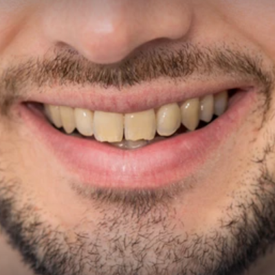 Close-up of a person's smiling mouth. Yellowish teeth, visible beard, and pink lips.