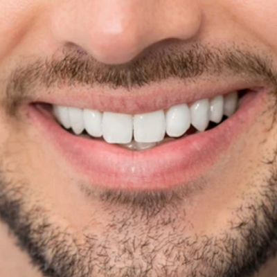 Close-up of a smiling mouth with bright white teeth and a groomed beard.
