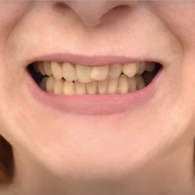 Close-up of a person's mouth with visible teeth. Teeth appear discolored, and the lips are slightly parted.