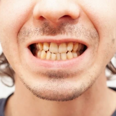 Close-up of a person’s mouth, showing clenched teeth that are yellowed.