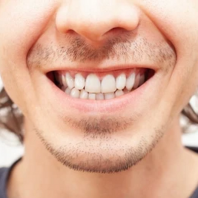 Close-up of a smiling mouth with straight, white teeth. Person has a mustache and goatee.