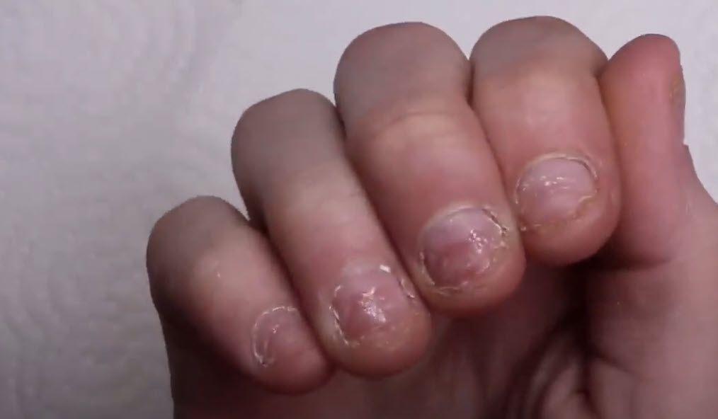 photo of a hand with nails that have been badly bitten