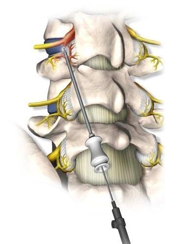 Medical illustration of a needle entering the spine, possibly for an injection or biopsy.