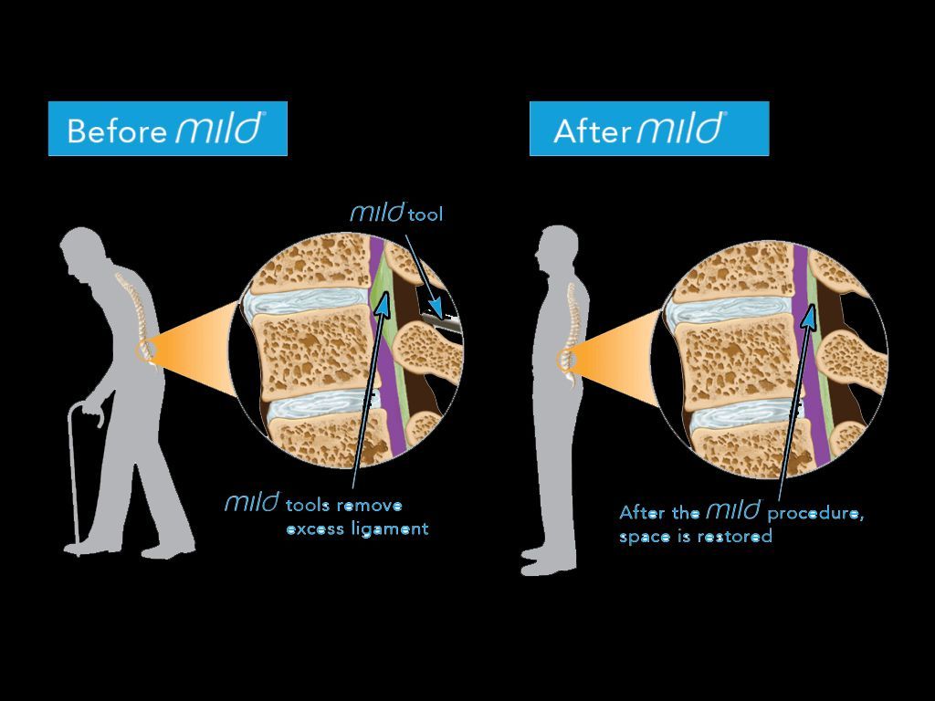 Diagram comparing spinal posture before and after a MILD procedure. Before: hunched over, after: upright. Detail shows ligament removal.