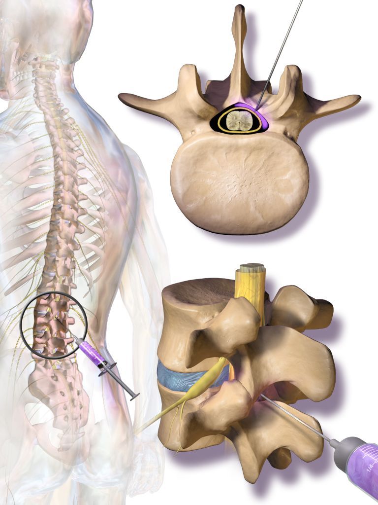 Illustration of a lumbar spine injection, showing a needle targeting the spinal area for pain relief.