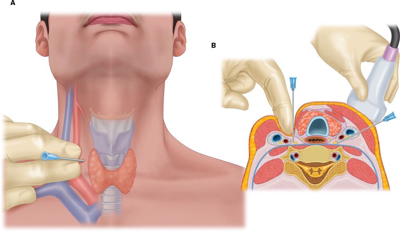 Medical illustrations of a needle biopsy of gang block. A hand guides the needle. Ultrasound scan is present.