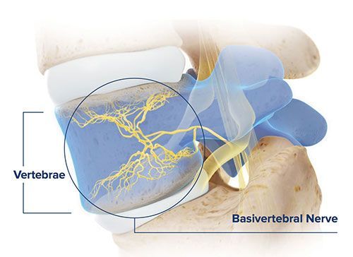 Medical illustration of vertebrae with basivertebral nerve highlighted in yellow.