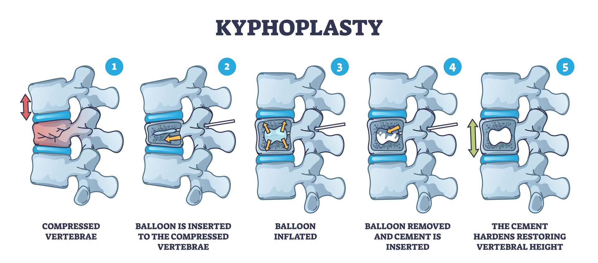 Kyphoplasty procedure: compressed fracture, balloon inserted, inflated, cement injected, vertebral height restored.