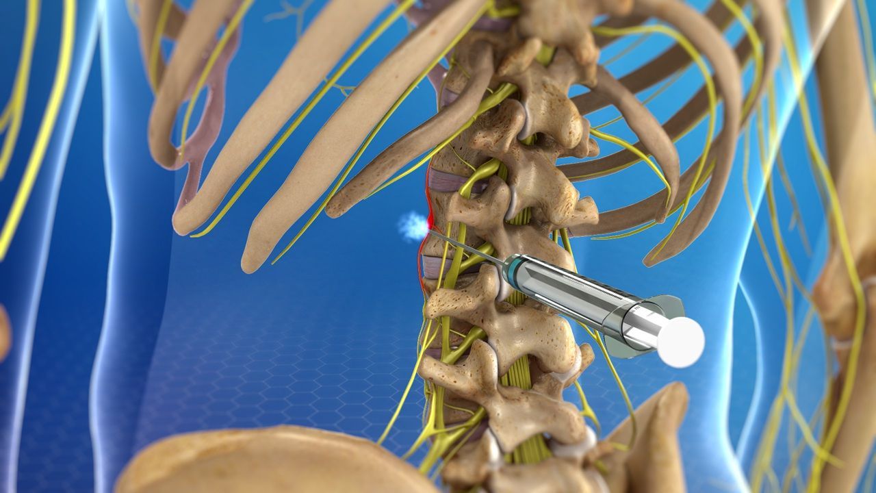 Medical illustration of lumbar spine, with needle inserting medication near spinal nerves.