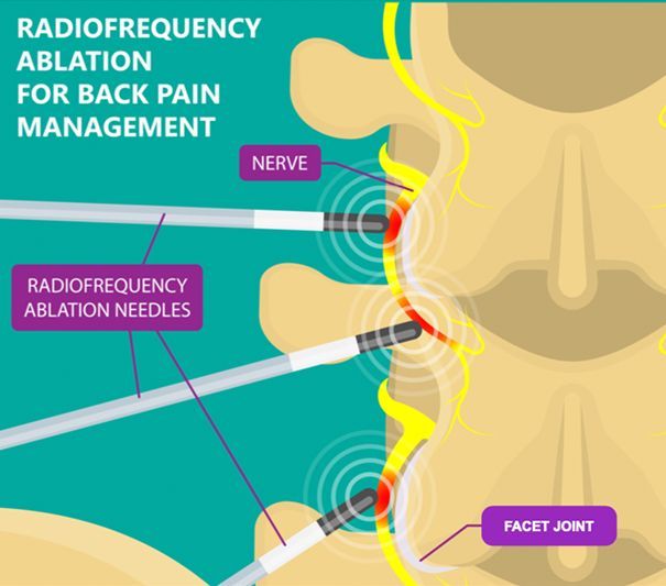 Diagram of radiofrequency ablation for back pain. Needles target facet joints and nerves in the spine.