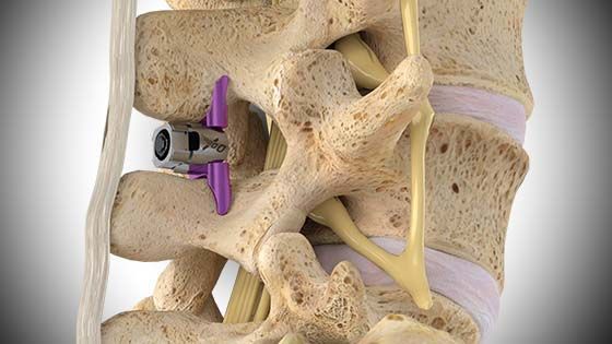Illustration of lumbar spine with a spinal implant device in place. Beige bones with a purple and gray implant. Vertiflex