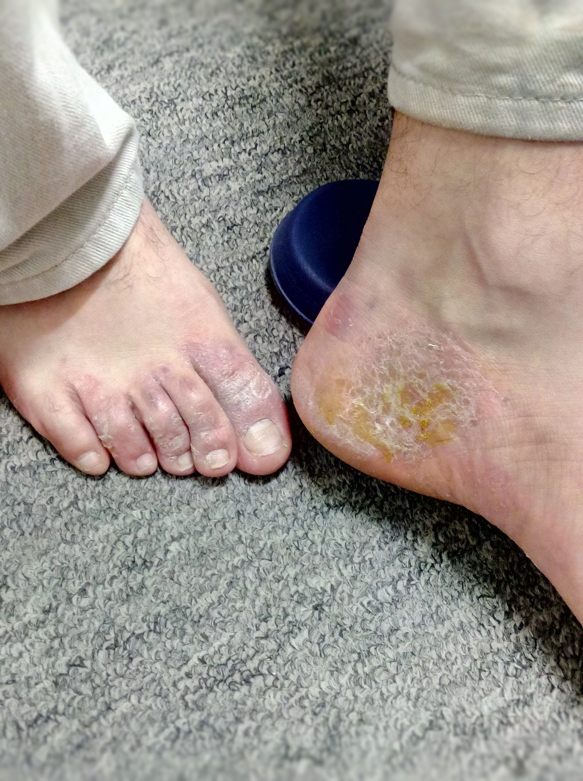 Psoriasis, Eczema, Rash, Dermatitis,