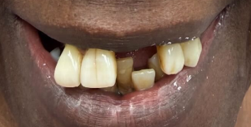 Before Dental Implants