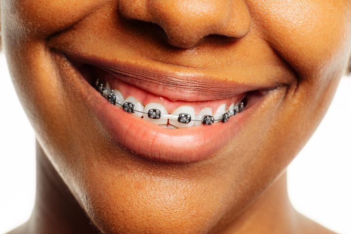A woman with braces is smiling while sitting in a dental chair.