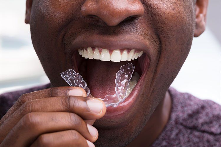 man is about to use an invisalign product