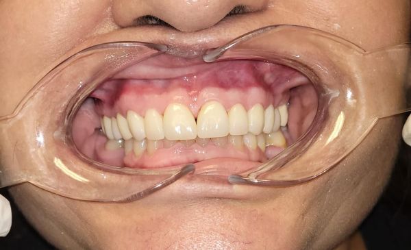 After Invisalign