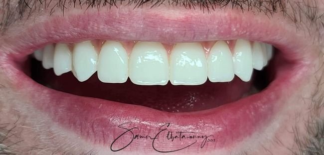 After Full Mouth Rehabilitation