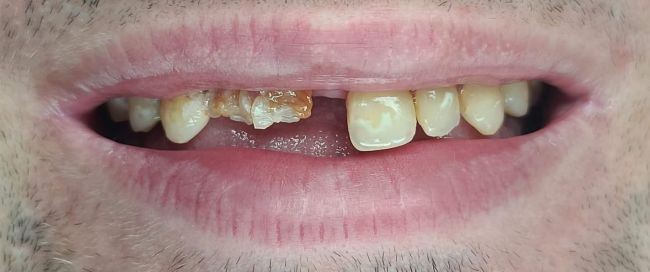 Before Full Mouth Rehabilitation