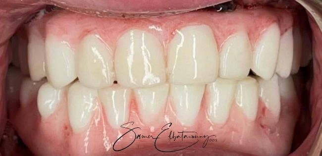 After Full Mouth Rehabilitation
