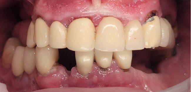Before Dental Veneers