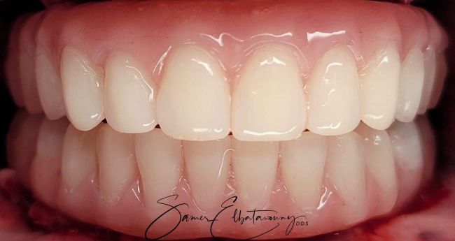 After Dental Implants