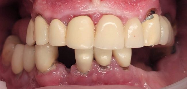 Before Dental Implants