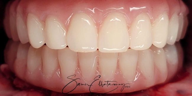 After Dental Veneers