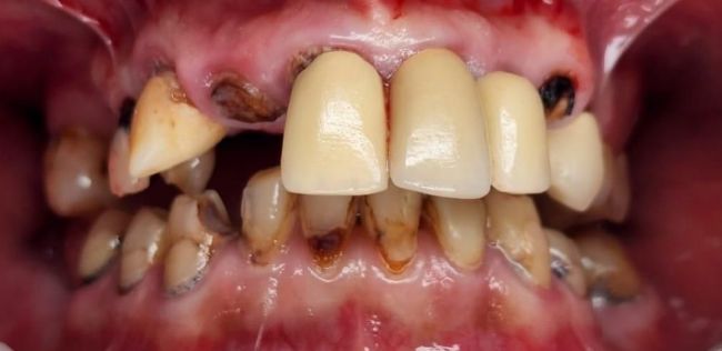 Before Full Mouth Rehabilitation