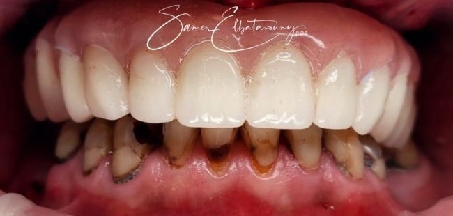After Full Mouth Rehabilitation