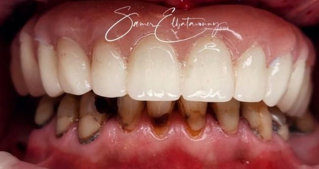 After Dental Implants