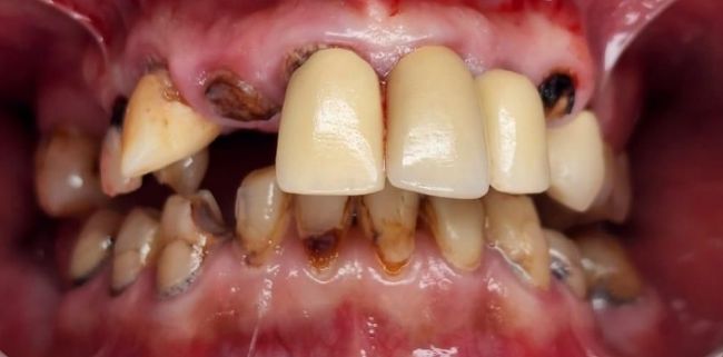 Before Dental Implants