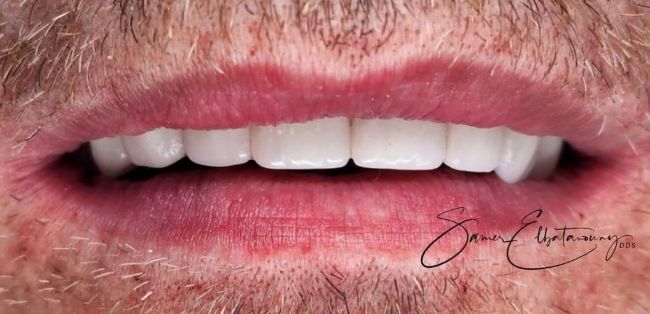 After Dental Veneers