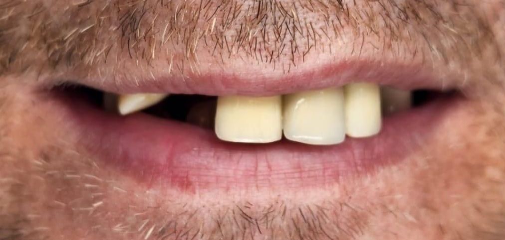 Before Dental Veneers