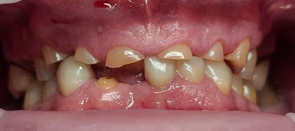 Before Full Mouth Rehabilitation