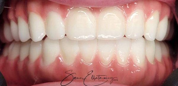 After Full Mouth Rehabilitation