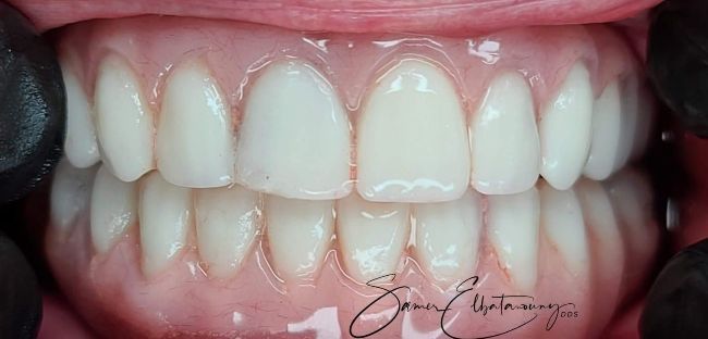 After Gum Contouring