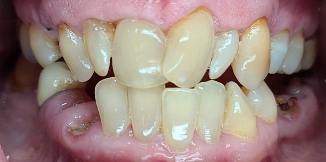 Before Gum Contouring